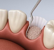 Illustration showing bone graft in empty tooth socket
