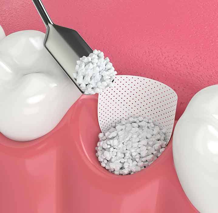 Digital illustration of bone grafting