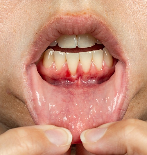 Man showing signs of gum recession before gum graft in Salt Lake City, UT