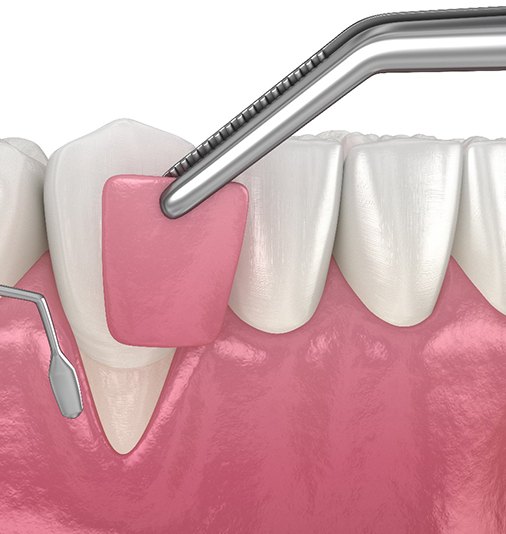 Illustration of procedure for gum graft in Salt Lake City, UT