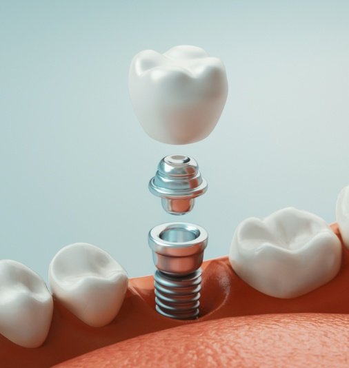 Animated dental implant supported replacement tooth placement