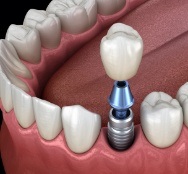 Animated dental implant supported dental crown placement