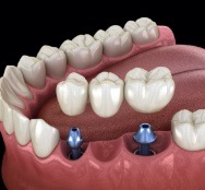 Animated dental implant supported fixed bridge placement