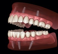 Animated dental implant supported denture placement