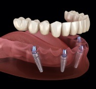 Animated dental implant supported all on four denture placement