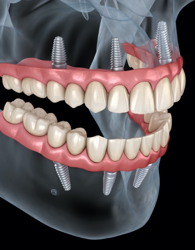 Animated dental implant supported denture
