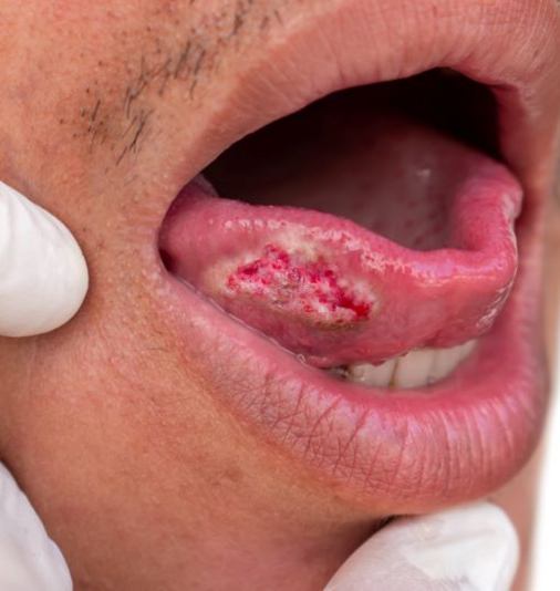 Patient’s tongue with spot of cancer