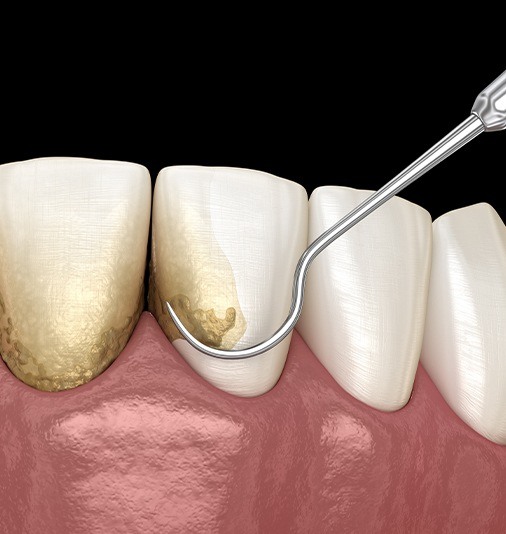 Animated smile during scaling and root planing treatment