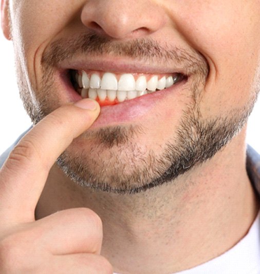 Man pulling down lip showing gum disease