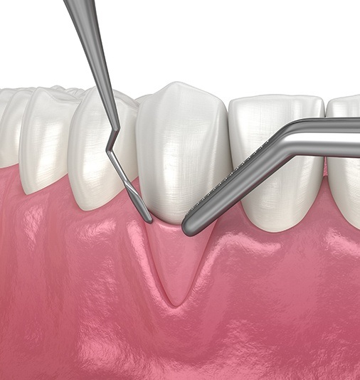 Animated smile during gum grafting treatment