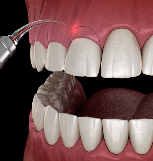 Animated smile during crown lengthening surgery