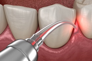 Digital image of laser dentistry procedure