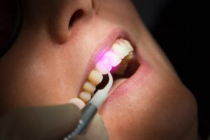 Dental laser used for crown lengthening