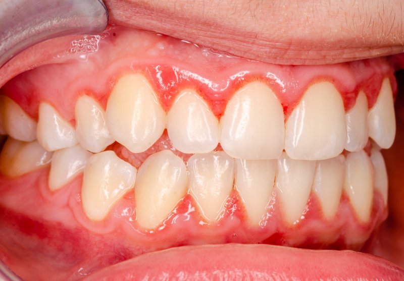 person with gum disease 