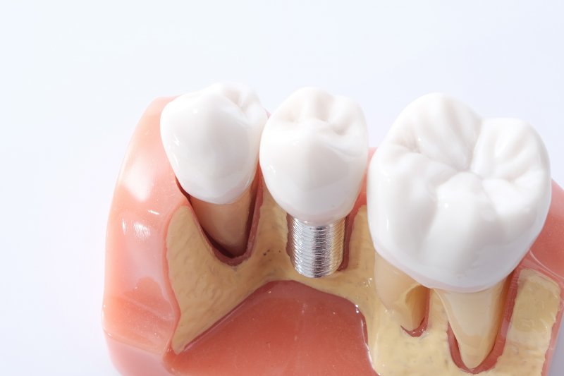 Model of the lower arch with a dental implant