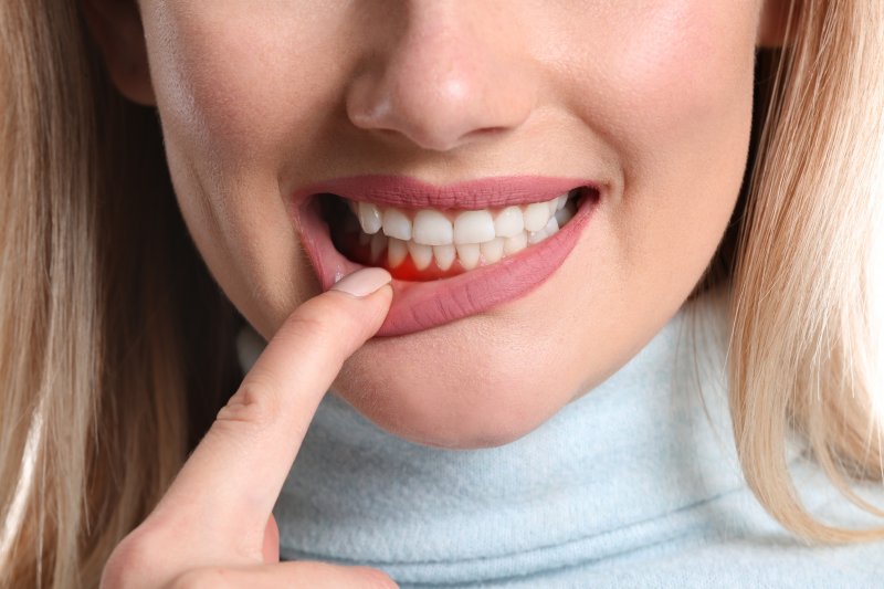 A woman showing her gum disease