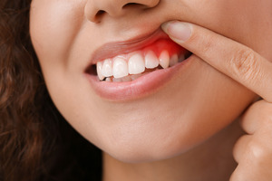 Pulling up lip to show inflamed gums